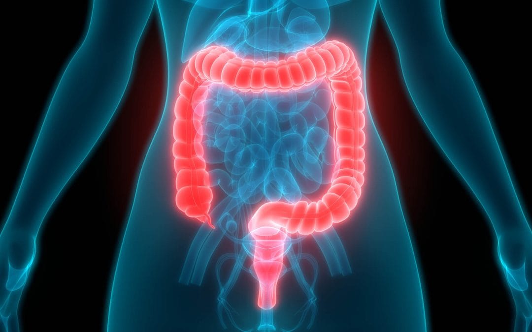 Colon Cancer is Preventable